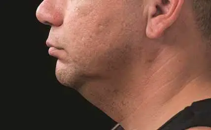 how to get rid of neck fat