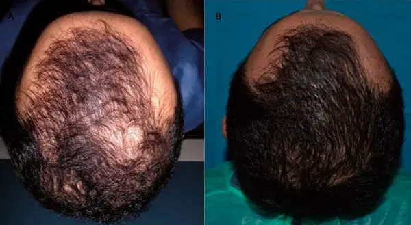 Hair loss before and after PRP