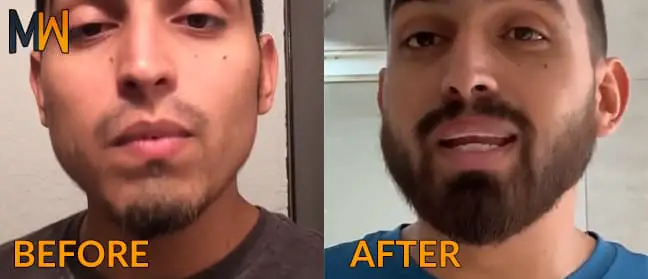 minoxidil beard before/after