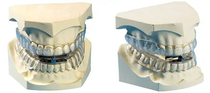 Image showing mandibular advancement devices used for overbite correction.