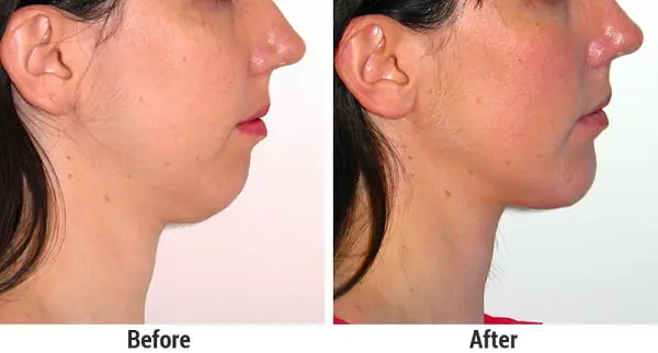 Ideal Chin Proportions for Women – Magnum Workshop