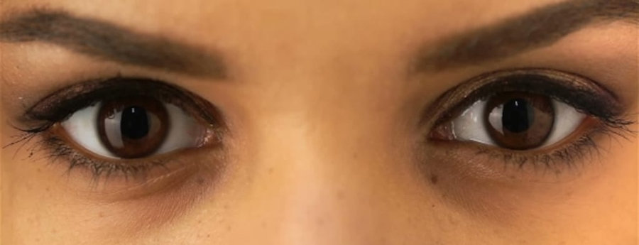 Surgery To Get Bigger Eyes Magnum Workshop