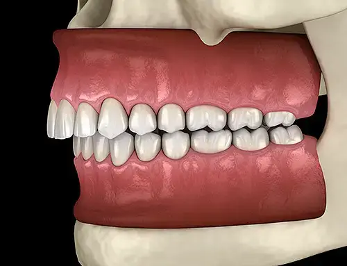 An illustration showing what an overbite looks like.