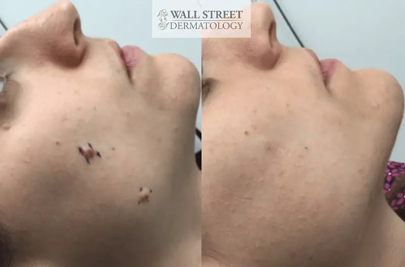 Removing Moles Without Scarring Magnum